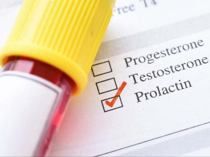 Prolaktin hormonunun yüksekliği