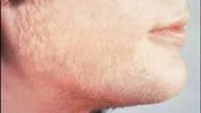 Polikistik Over  PCO Nedir?